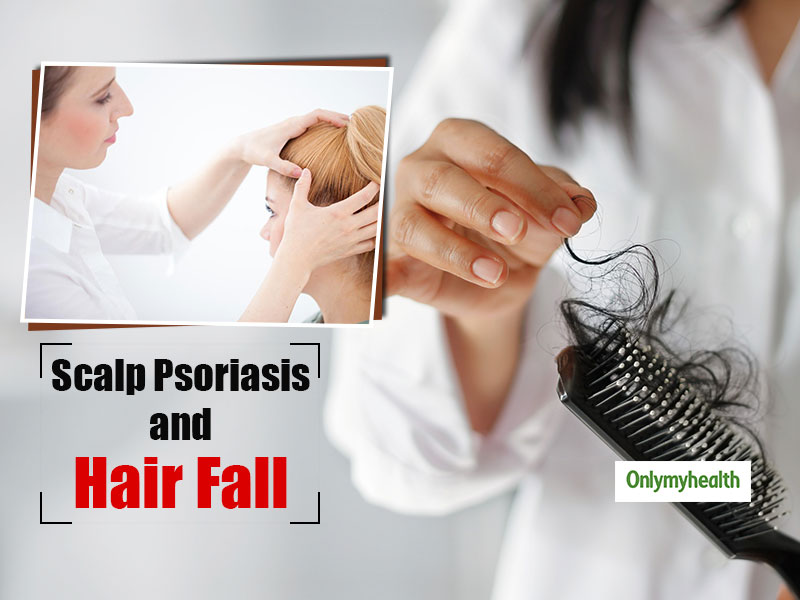 Does Scalp Psoriasis Cause Hair Fall? Know From The Doctor